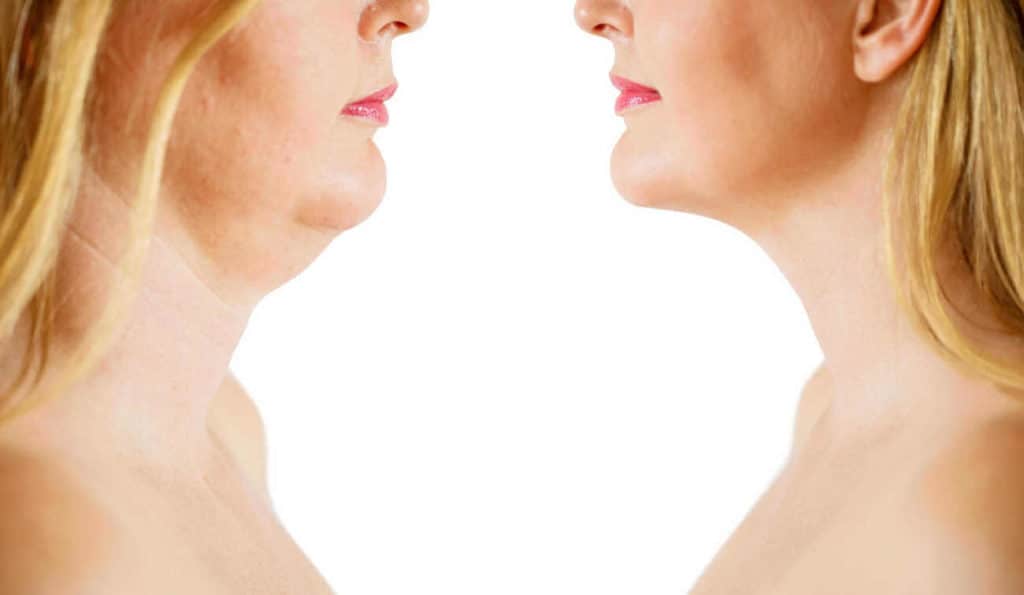 Double Chin treatment Wales before and after results