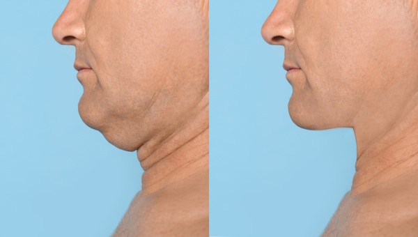 Which Non-Surgical Treatments Work Best for Jowls and Loose Skin Wales?