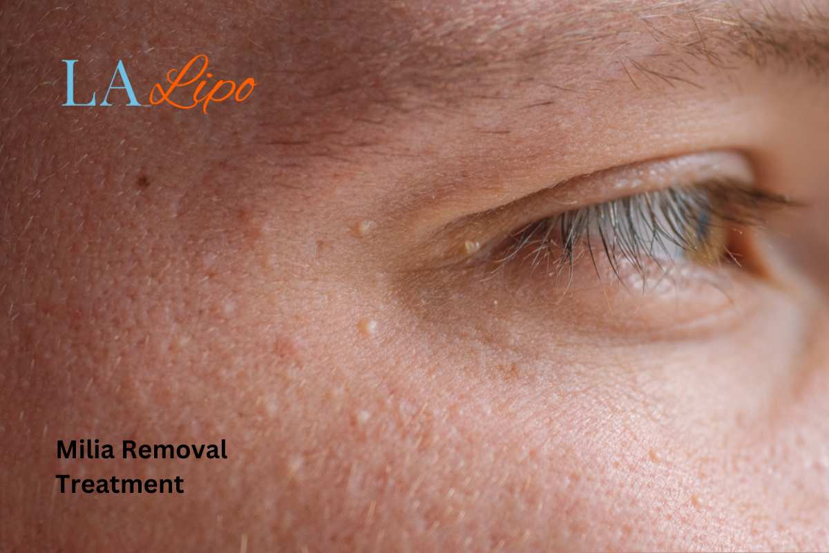Cryopen Milia Removal: Is It the Easiest and Safest Option Wales?