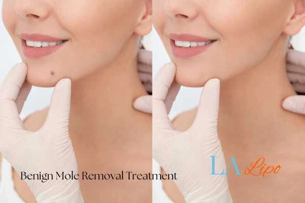 Before-and-after results following benign mole-removal treatment Wales