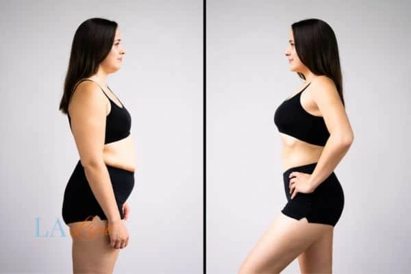 image of woman before and after results of LA-EMS Body Sculpting Wales to help treat Diastasis recti