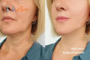 hi-fu for wrinkles Wales before and after results