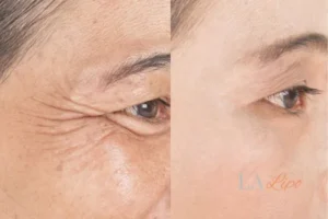 Before and after results of woman - HI-fu wrinkles reduction treatment Wales