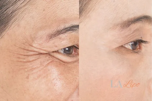 Before and after results of woman - HI-fu wrinkles reduction treatment Wales