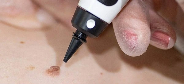 skin tag removal using cryopen Wales