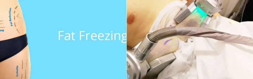 Fat freezing Wales on multiple areas of the body