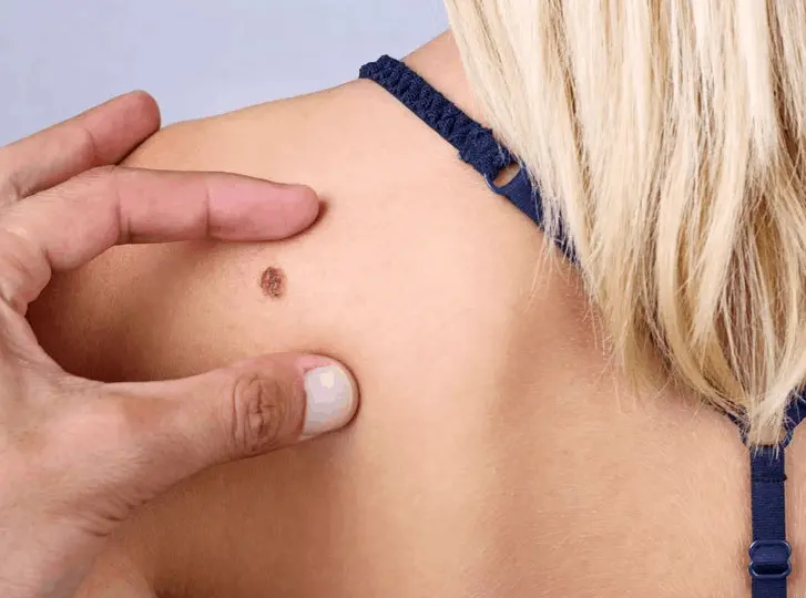 woman having mole removal Wales consultation before treatment.