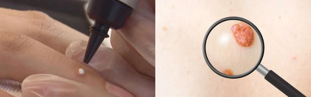 CryoPen practitioner Wales assessing a benign mole before treatment