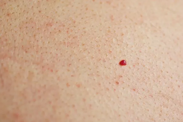 close up of a cherry angioma Wales