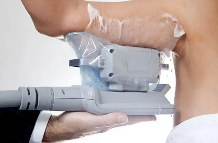Picture of fat freezing Wales on the upper arms.