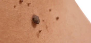image of a skin tag Wales