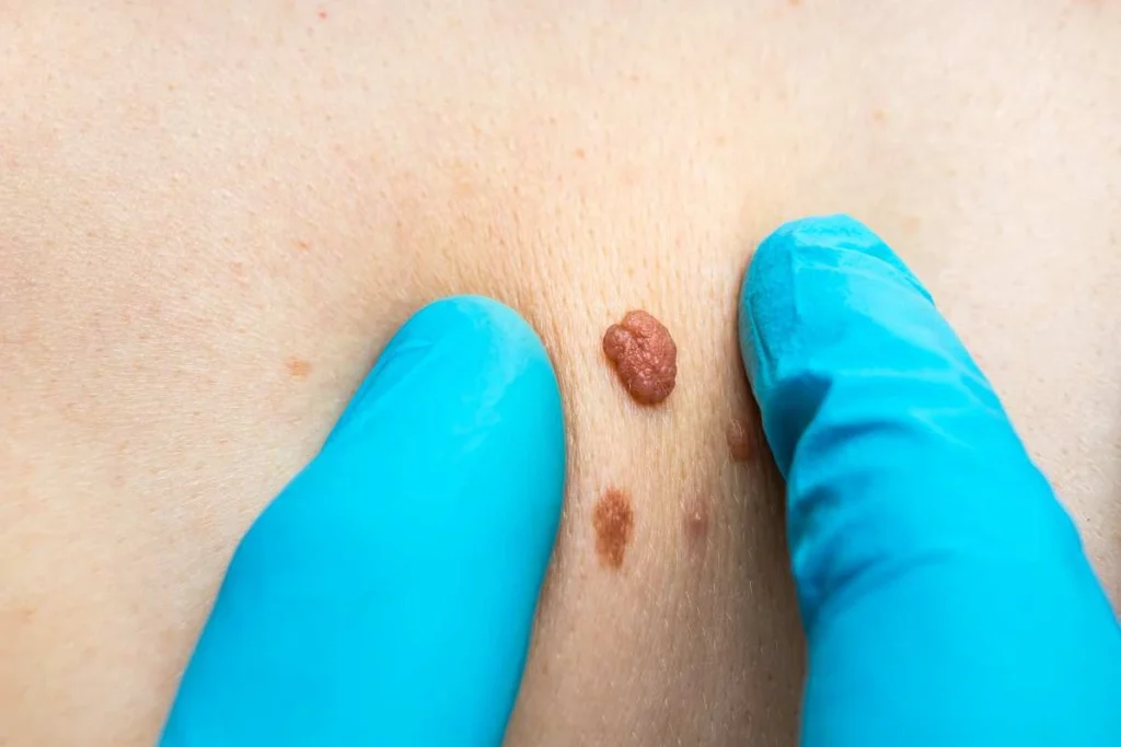 Consultant examining a skin tag Wales
