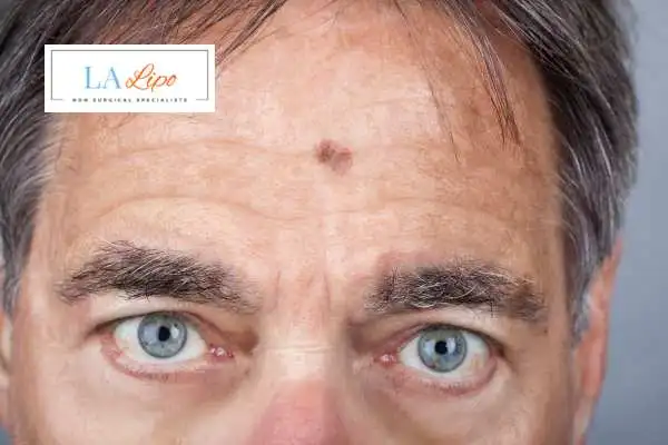 Solar Lentigo Removal Wales image of man with mark on his forehead