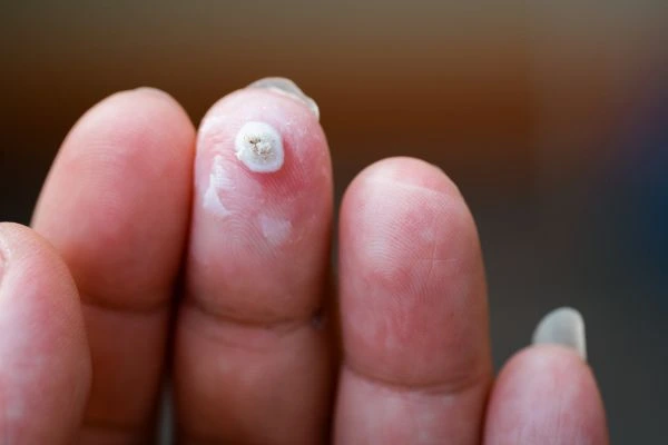 wart on person finger - cryotherapy to treat from LA LIPO Wales