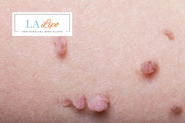 Does cryopen skin tag removal Wales hurt? Find out now call our team today!
