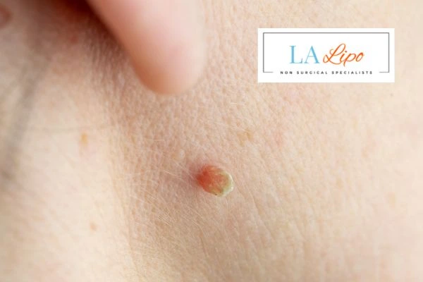 Book skin tag removal Wales today speak to our team now!