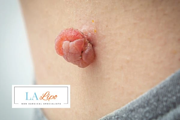 Interested in skin tag removal Wales? Concerned about the pain? Find out more today!
