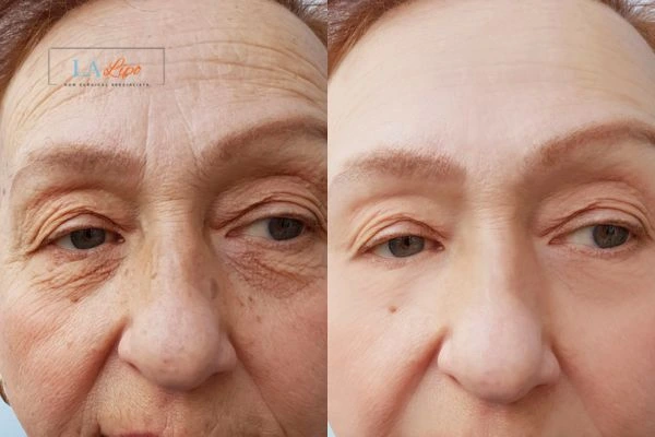 The powerful benefits of Morpheus8 Treatment Wales - Call Our team today!