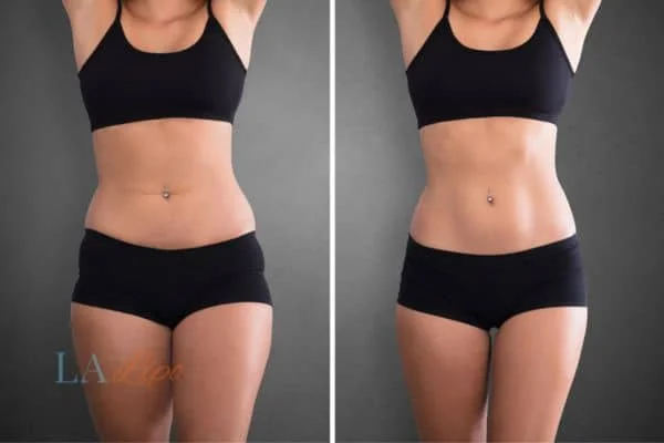 before and after results of non-surgical treatment to help a woman's body image and mental health Wales