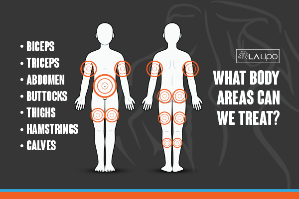 Diagram to show areas you can have LA-EMS Body Sculpting Treatment Wales