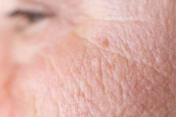 close up picture of a woman's face showing an age spot Wales
