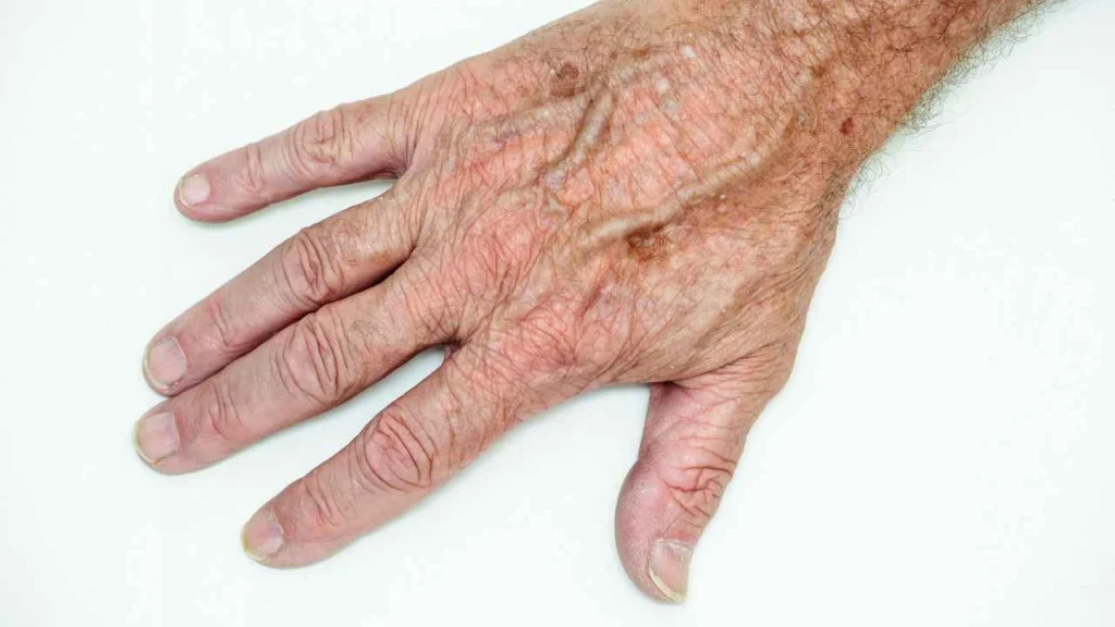 Male hand showing age spot Wales