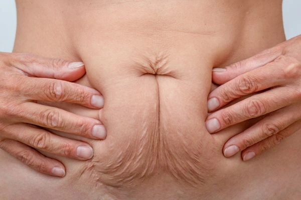 Should I Combine Diastasis Recti Treatment with Body Contouring for Better Results Wales?