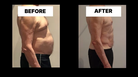 What Symptoms Can Diastasis Recti Cause in Men? Weak Core, Back Pain and Poor Posture Wales